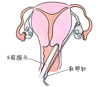 小儿退烧推拿手法 5种烟台捐卵宝宝退烧按摩方法